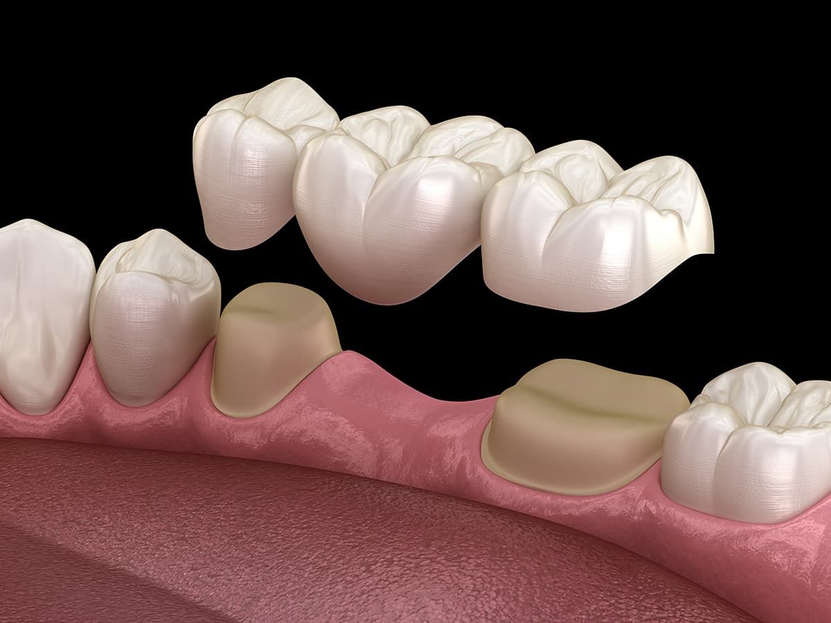 Custom-designed dental bridge showing crown and pontic